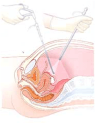 腹腔鏡検査