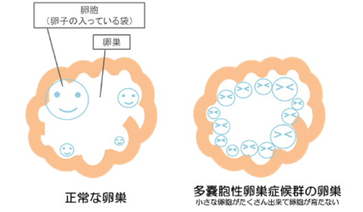 多嚢胞性卵巣症候群